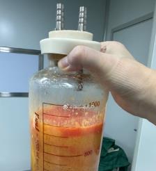 鹤岗水动力吸脂手术要做多久？